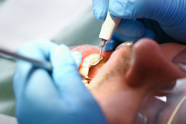 Best Emergency Tooth Extraction in Grover, WY