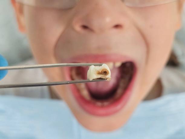 Best Emergency Dental Care for Broken or Chipped Teeth in Grover, WY